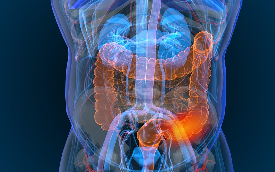 Полипы у близких родственников повышают риск заболевания раком кишечника.