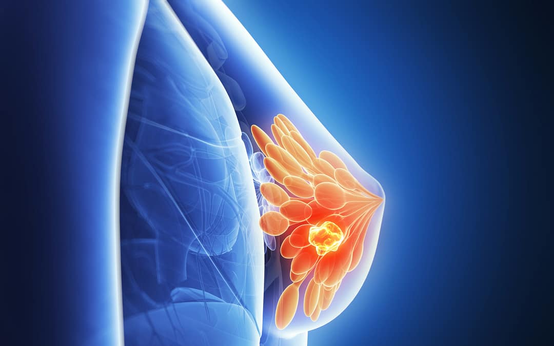 Smarter cancer care- индивидуальное лечение для пациенток с раком груди