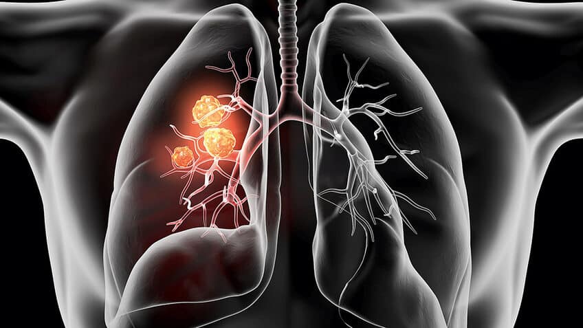 Новый метод быстрого определения мутаций при раке легких