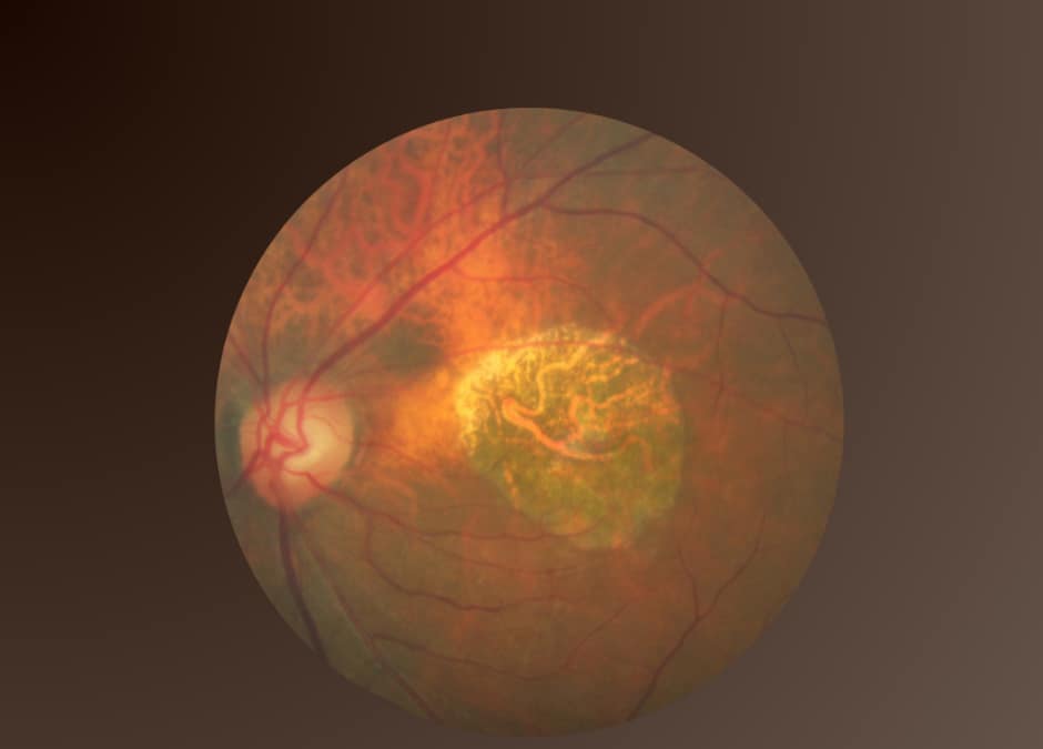 Возрастная макулярная дегенерация: имплант PRIMA- новый рубеж в лечении слепоты